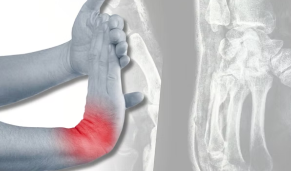 Запястья в опасности: руководство для адептов боевых искусств по травмам запястий